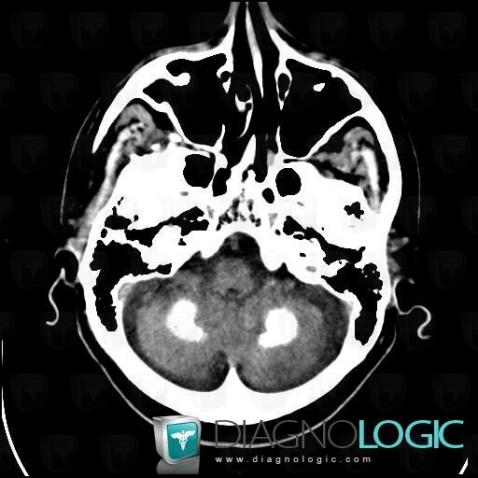 Fahr's disease, Cerebellar hemisphere, CT