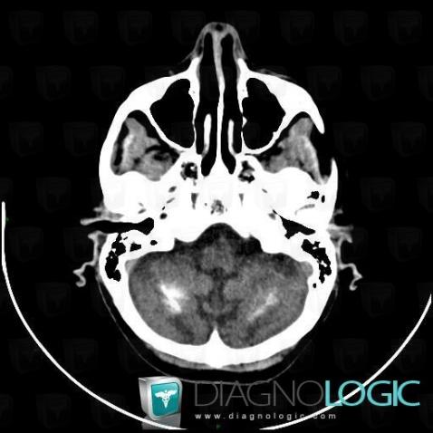 Fahr's disease, Cerebellar hemisphere, CT