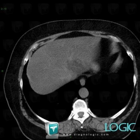 Fatty infiltration, Liver, CT