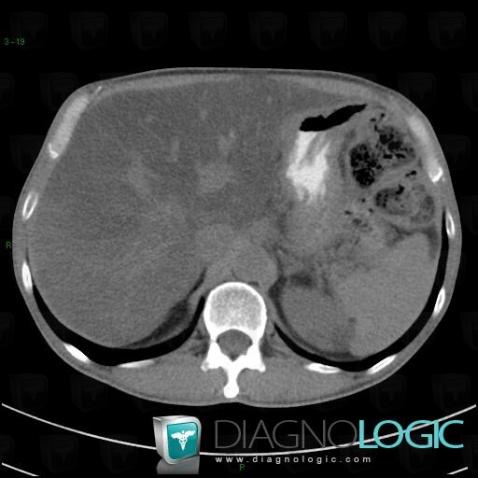 Fatty infiltration, Liver, CT