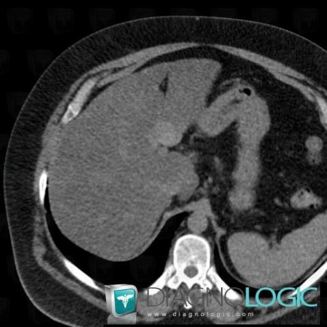 Fatty infiltration, Liver, CT