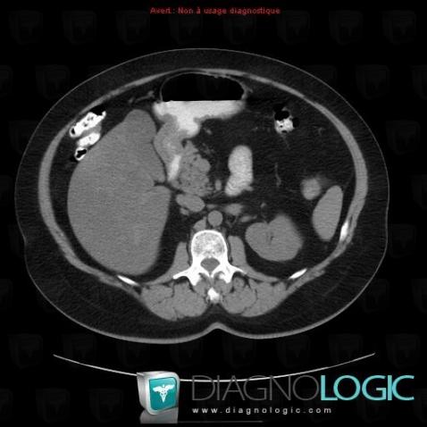 Fatty infiltration, Liver, CT