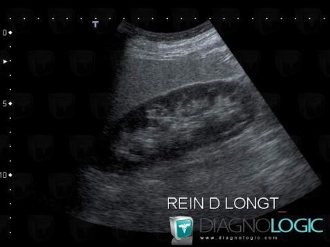 Fatty infiltration, Liver, US