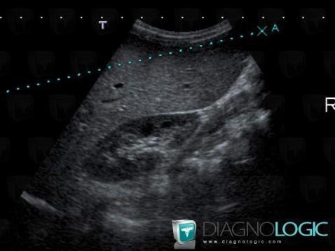 Fatty infiltration, Liver, US