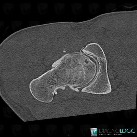 Femoroacetabular impingement, Coxo femoral joint, CT