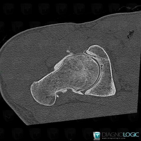 Femoroacetabular impingement, Femur - Proximal part, CT