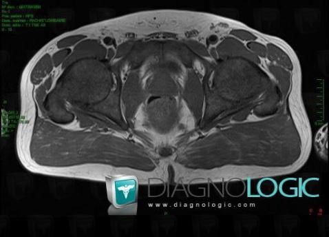 Femur - Proximal part, MRI