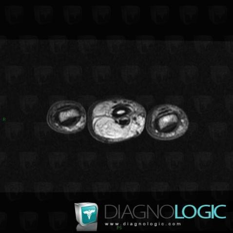 Radiology case : Fibrolipoma (MRI) - Diagnologic