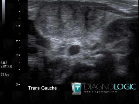 Fibromatosis colli, Deep neck spaces, US