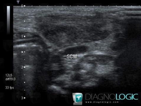 Fibromatosis colli, Deep neck spaces, US