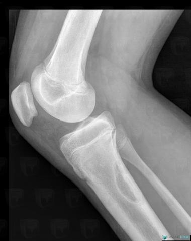 Fibrome non ossifiant, Tibia -supérieur, Radio