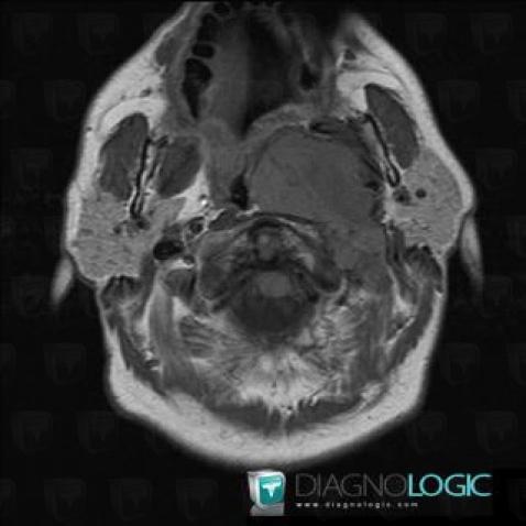 Fibrosarcoma, Deep facial spaces, MRI