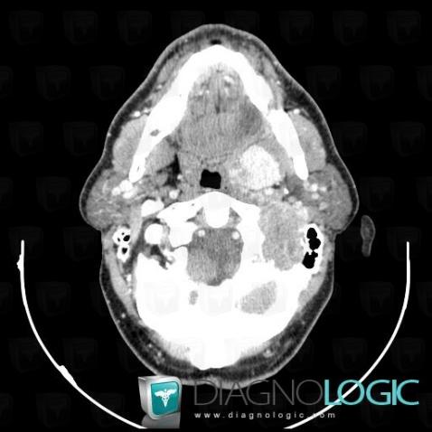 Fibrosarcoma, Jugular foramen, Deep facial spaces, CT