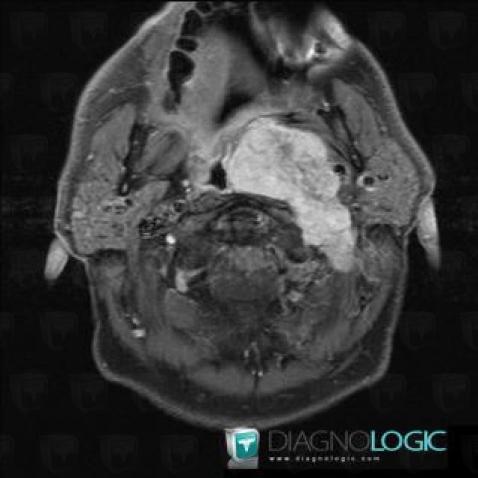 Fibrosarcoma, Jugular foramen, MRI