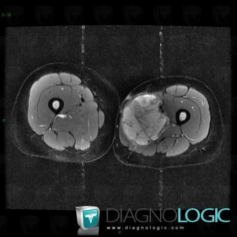 Fibrosarcoma, Muscles - Thigh, Other soft tissues/nerves - Thigh, MRI