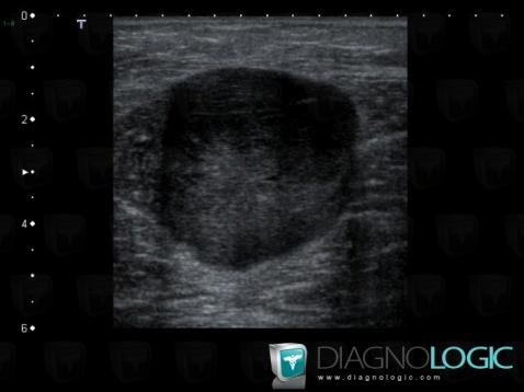 Fibrosarcoma, Muscles - Thigh, Other soft tissues/nerves - Thigh, US