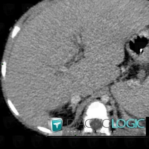 Fibrose, Foie, Scanner