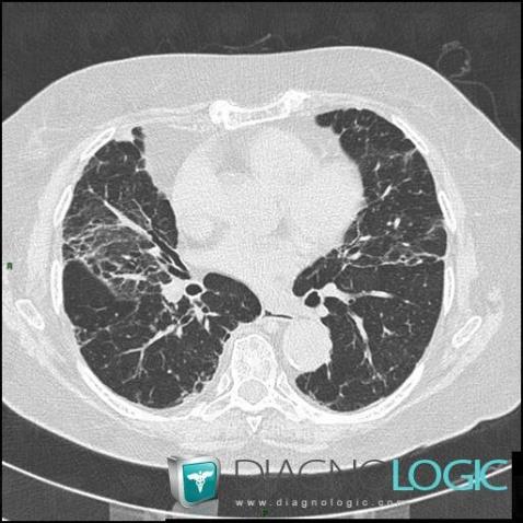 Fibrose pulmonaire d'origine médicamenteuse, Parenchyme pulmonaire, Scanner