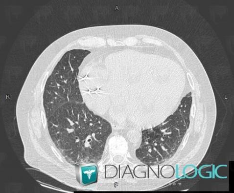 Fibrose pulmonaire d'origine médicamenteuse, Parenchyme pulmonaire, Scanner