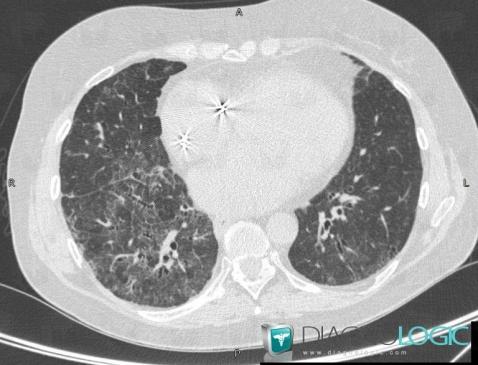 Fibrose pulmonaire d'origine médicamenteuse, Parenchyme pulmonaire, Scanner