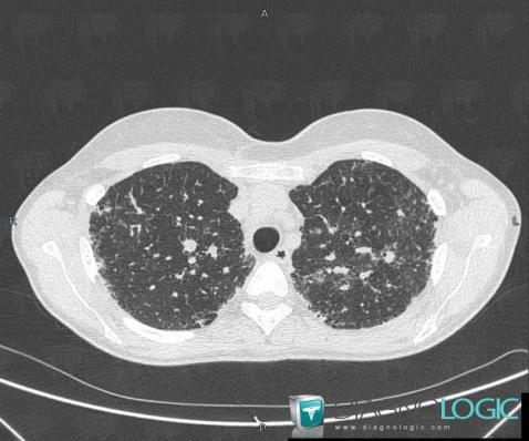 Fibrose pulmonaire, Parenchyme pulmonaire, Scanner