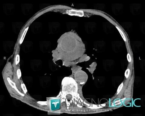 Fibrosing mediastinitis, Mediastinum, CT