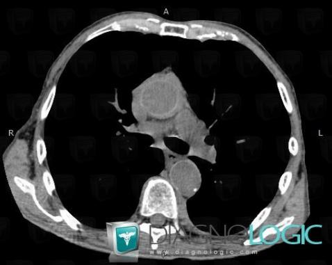 Fibrosing mediastinitis, Mediastinum, CT