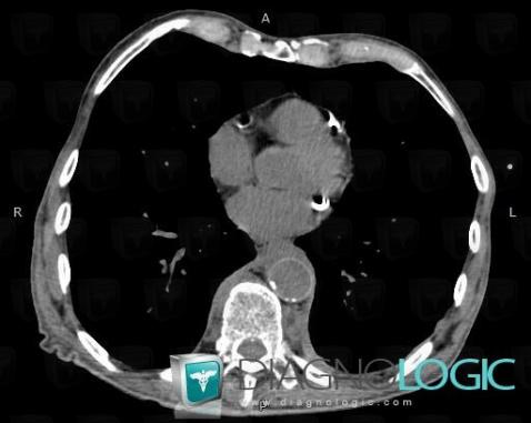 Fibrosing mediastinitis, Mediastinum, CT