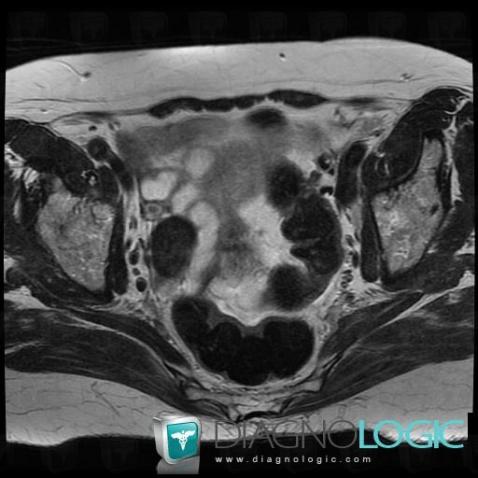 Fibrothecoma, Adnexa / Ovary fallopian tube, MRI