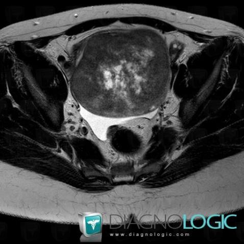 Fibrothecoma, Adnexa / Ovary fallopian tube, MRI