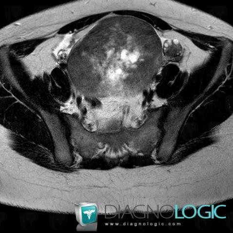 Fibrothecoma, Adnexa / Ovary fallopian tube, MRI