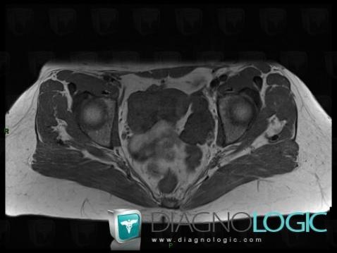 Fibrothecoma, Adnexa / Ovary fallopian tube, Pelvis / Perineum, MRI