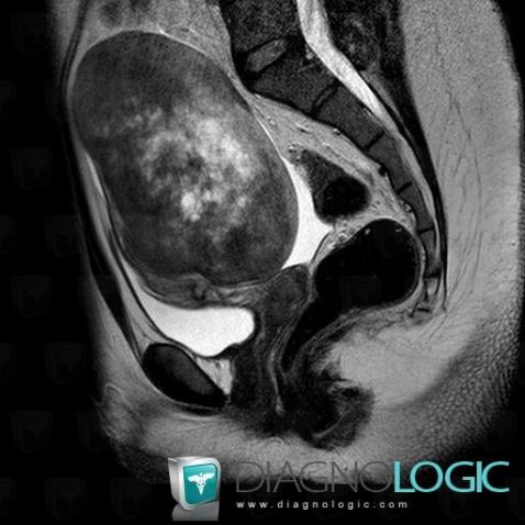 Fibrothecoma, Adnexa / Ovary fallopian tube, Pelvis / Perineum, MRI