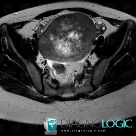 Fibrothecoma, Pelvis / Perineum, MRI