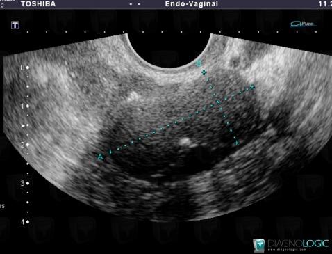 Fibrothécome , Annexe / Ovaire - trompe, Pelvis / Périnée, Echographie