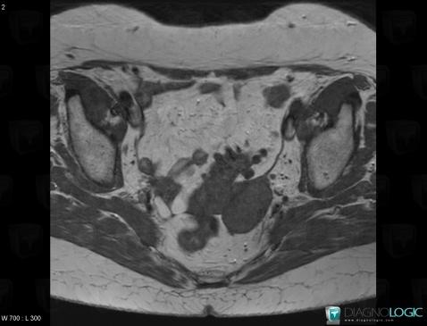 Fibrothécome , Annexe / Ovaire - trompe, Pelvis / Périnée, IRM