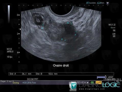 Fibrothécome , Pelvis / Périnée, Echographie