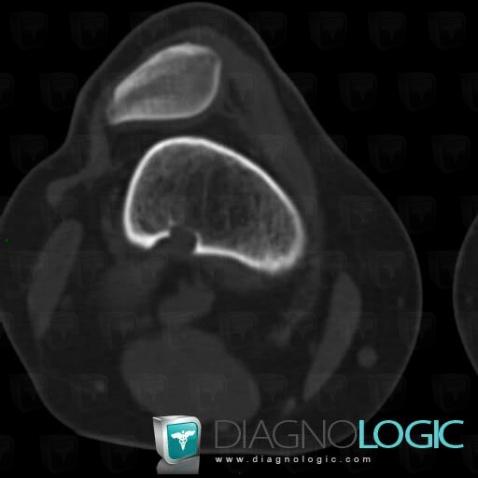 Fibrous cortical defect, Femur - Distal part, CT