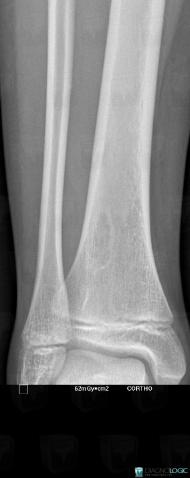Fibrous cortical defect, Tibia - Distal part, X rays