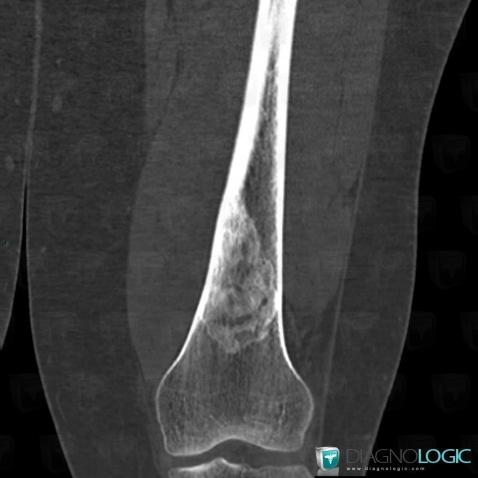 Fibrous dysplasia, Femur - Distal part, CT