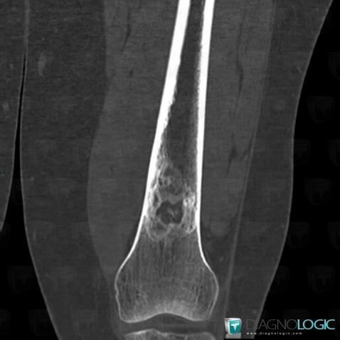 Fibrous dysplasia, Femur - Distal part, CT