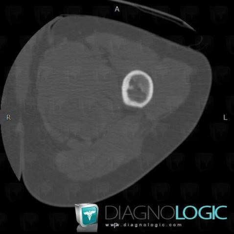 Fibrous dysplasia, Femur - Mid part, CT