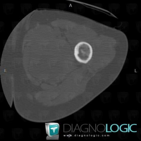 Fibrous dysplasia, Femur - Mid part, CT