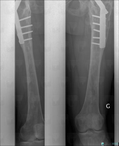 Fibrous dysplasia, Femur - Mid part, X rays