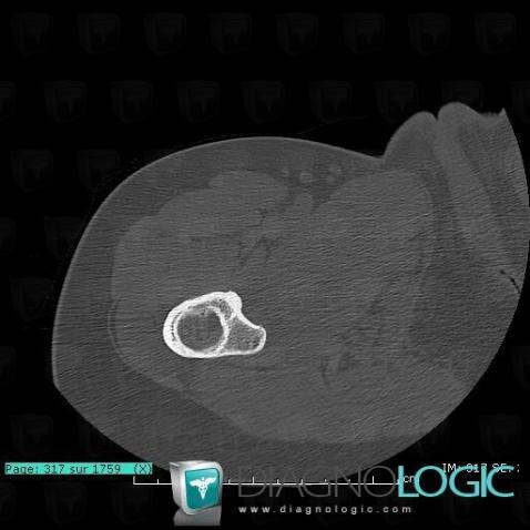 Fibrous dysplasia, Femur - Proximal part, CT