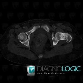 Fibrous dysplasia, Femur - Proximal part, CT