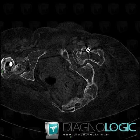 Fibrous dysplasia, Femur - Proximal part, CT