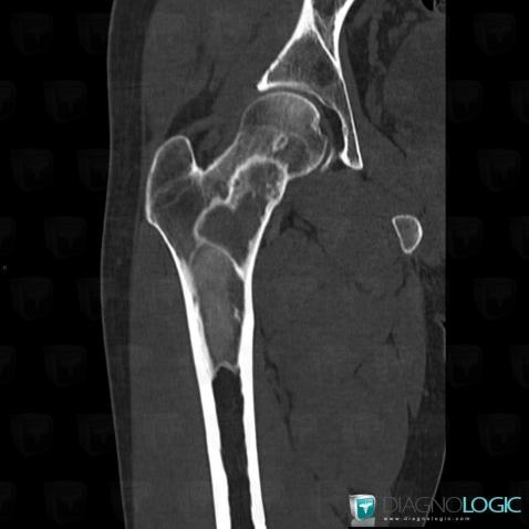 Fibrous dysplasia, Femur - Proximal part, CT