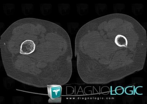 Fibrous dysplasia, Femur - Proximal part, CT