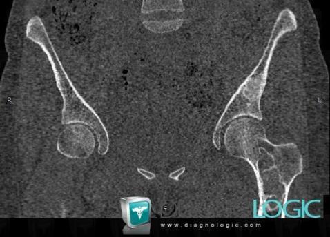 Fibrous dysplasia, Femur - Proximal part, CT